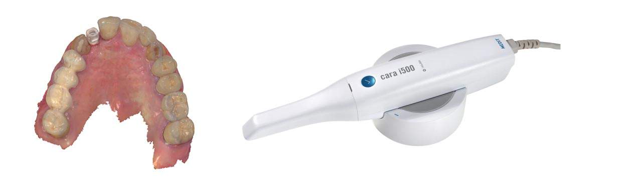 Scanner Intraorale